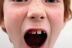 bleeding gums 